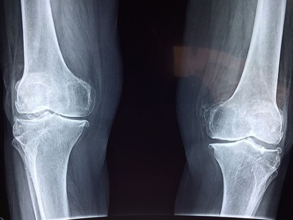 Omega-3's anti-inflammatory properties shows promising results for treating joint conditions such as osteoarthritis.